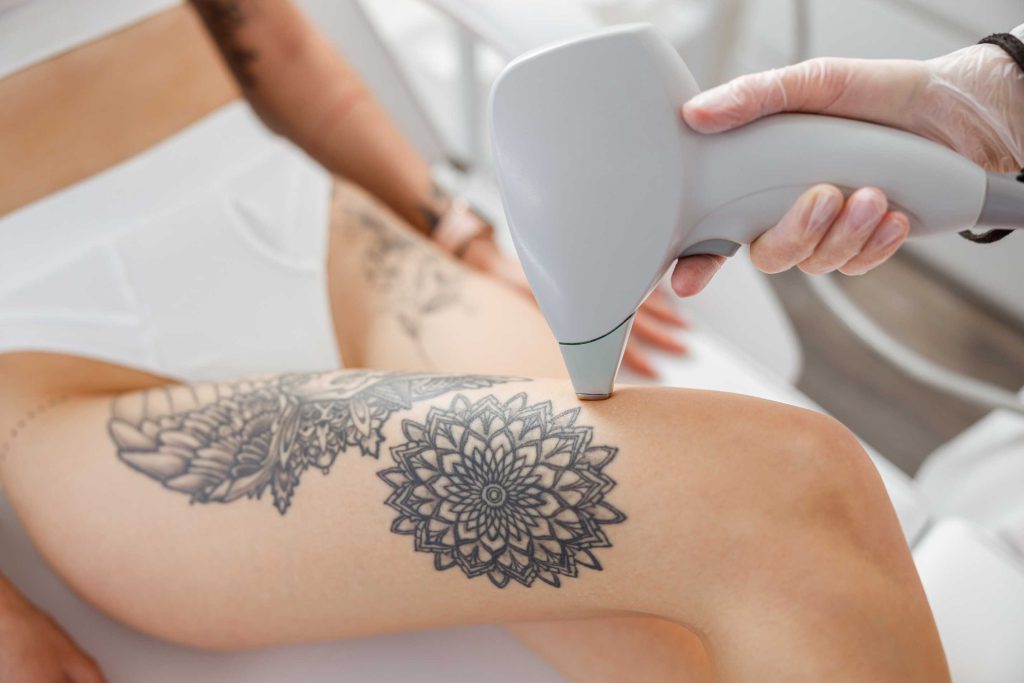 tatoeage verwijderen